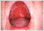 Candida svamp i munden
